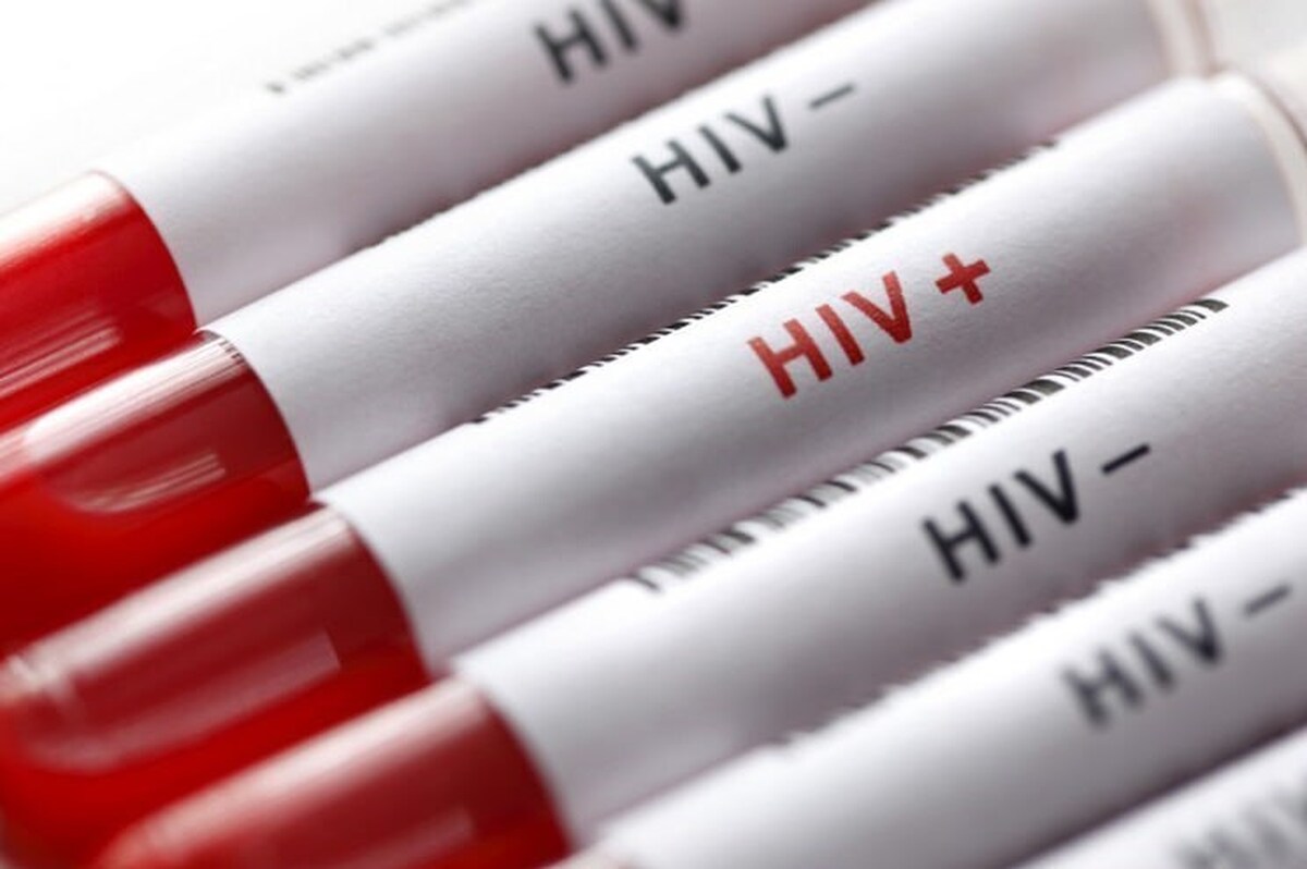 مهم‌ترین مسئله درباره ویروس HIV افزایش آگاهی و شناسایی مبتلایان است